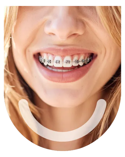 Orthodontist treatment in bandra west symphony dental clinic