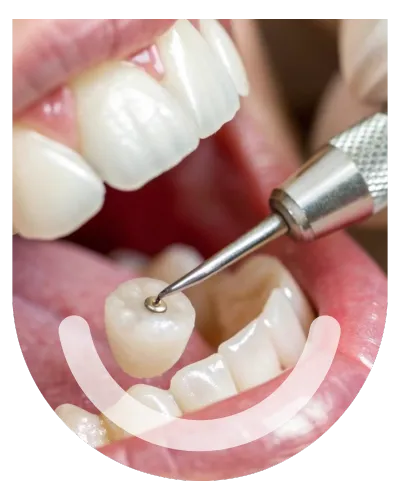 Restorative treatment in bandra west symphony dental clinic