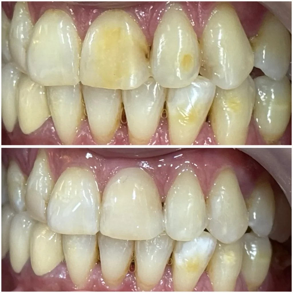 Aesthetic composite filling for discoloured and Fluorosed teeth