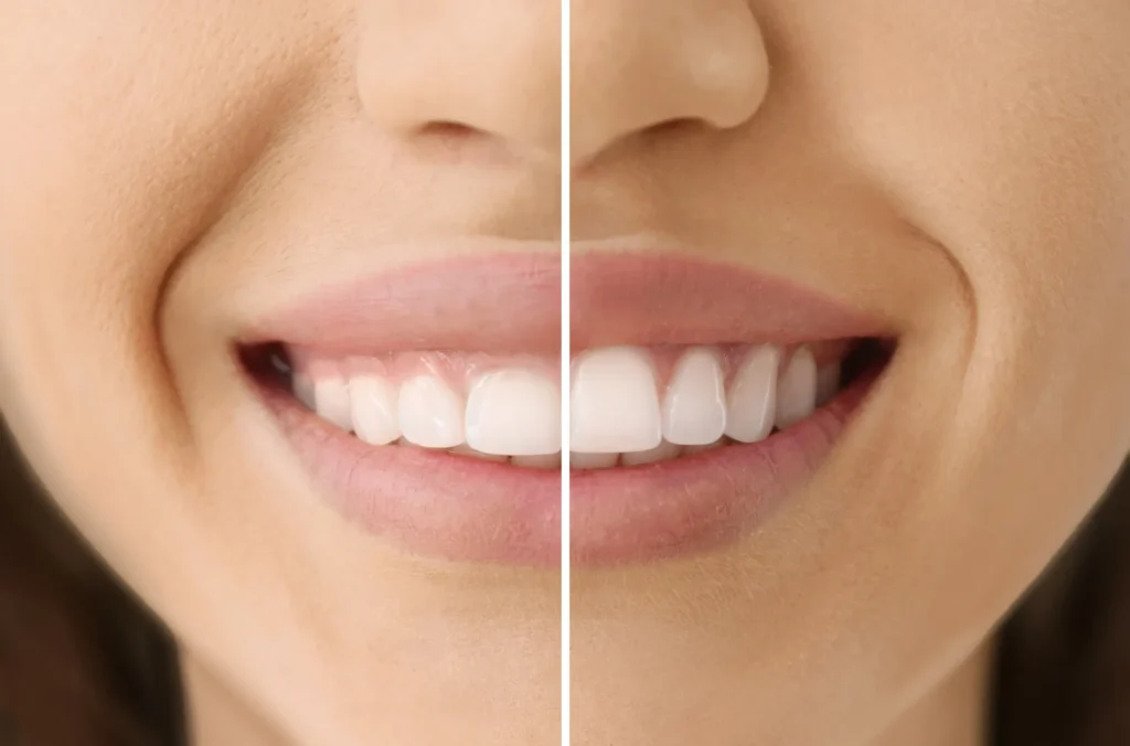 Cosmetic Gum Procedure in Bandra