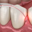 Cosmetic Gum Procedure in Mumbai