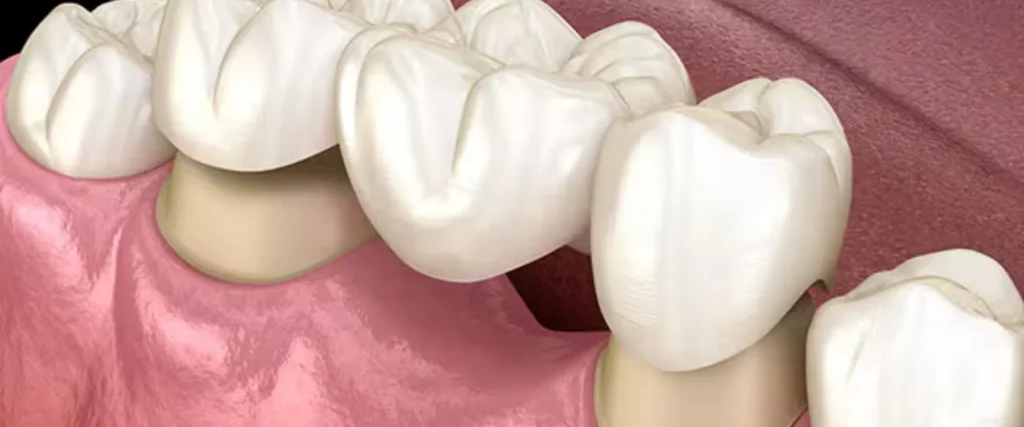 Dental Crowns & Bridges Treatment Khar West