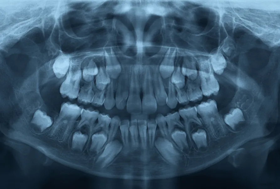 Dental diagnosis X-Ray in Bandra West