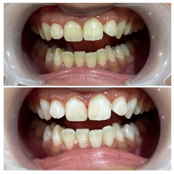 Groom teeth whitening