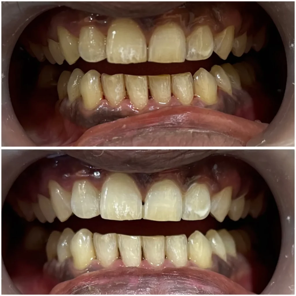 Instant Teeth Whitening Treatment Khar West