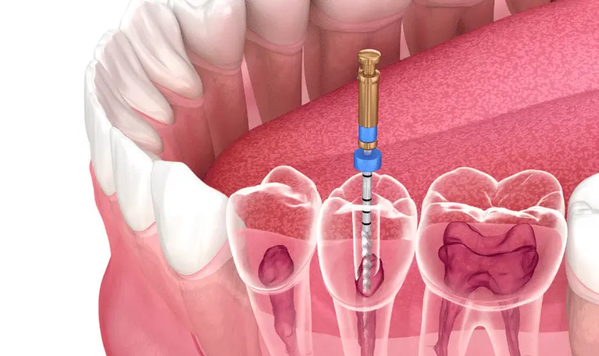Root Canal treatment