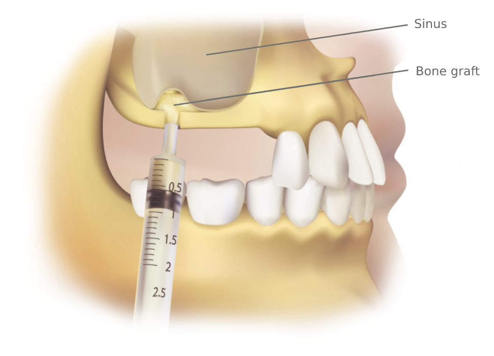 Bone Graft and Sinus Lift