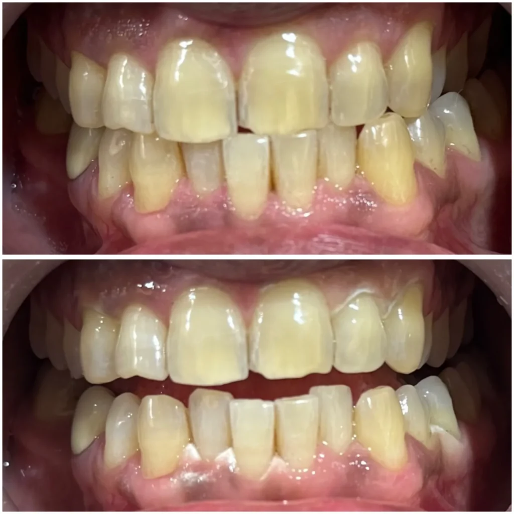 Teeth cleaning and Teeth whitening