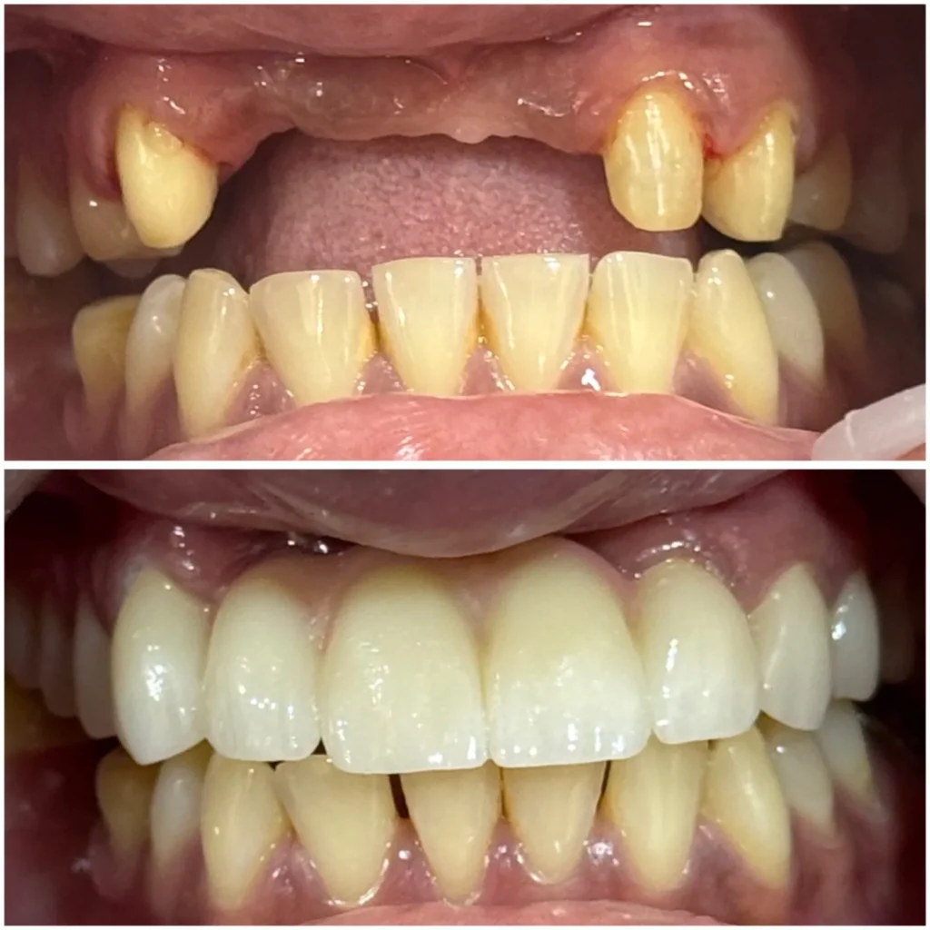 Zirconia Bridge Treatment