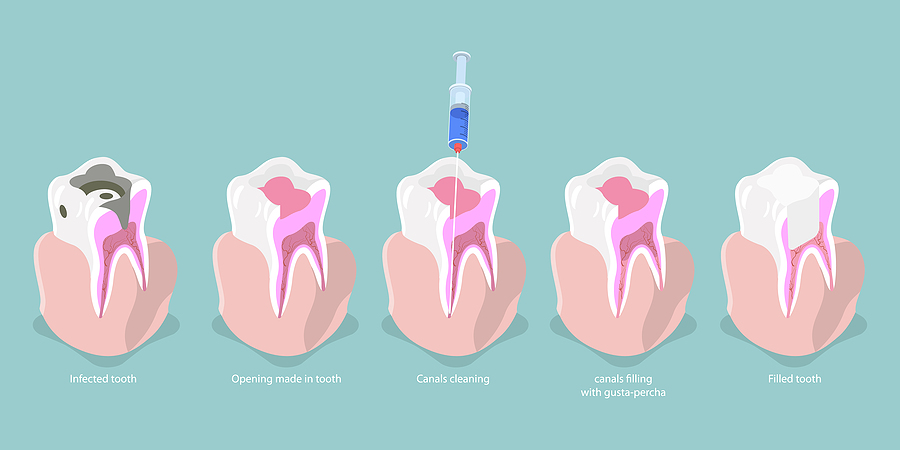 Root Canal Treatment