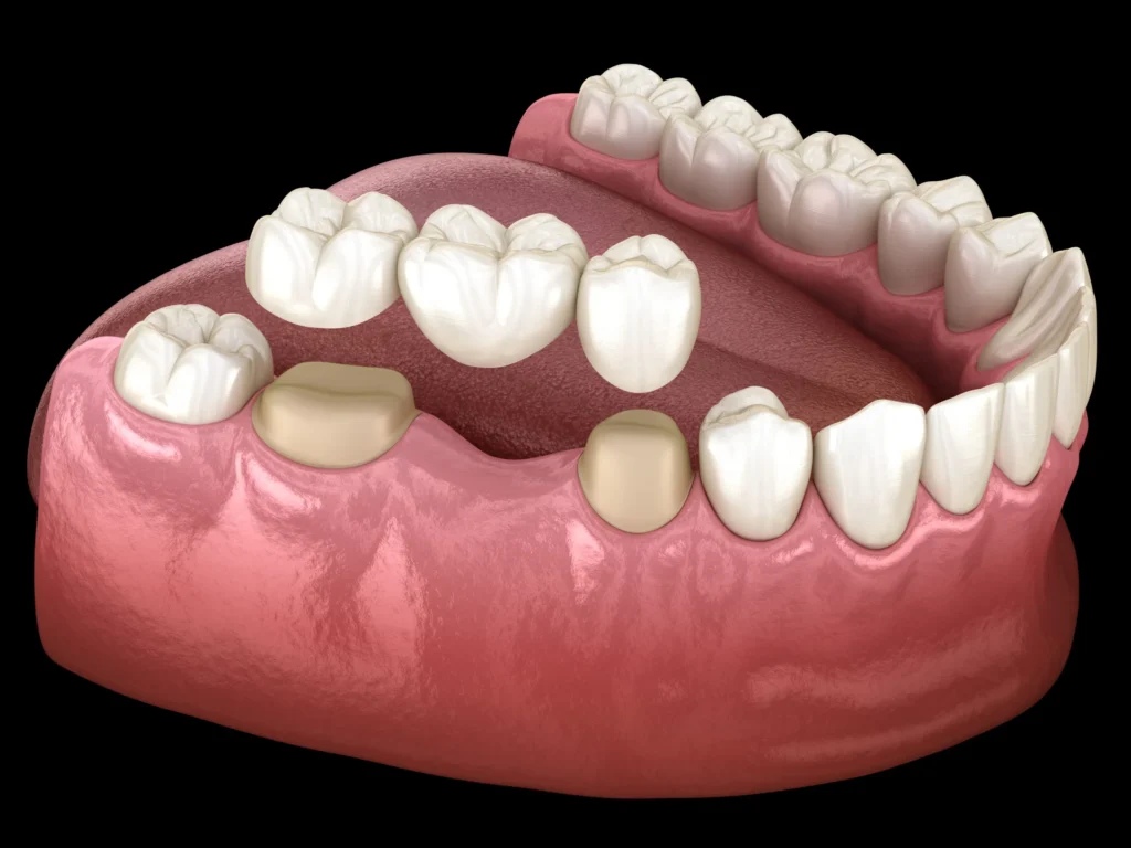 Dental Crowns and Bridges