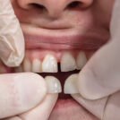 Dental Veneers Treatment