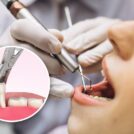 tooth-extraction khar west