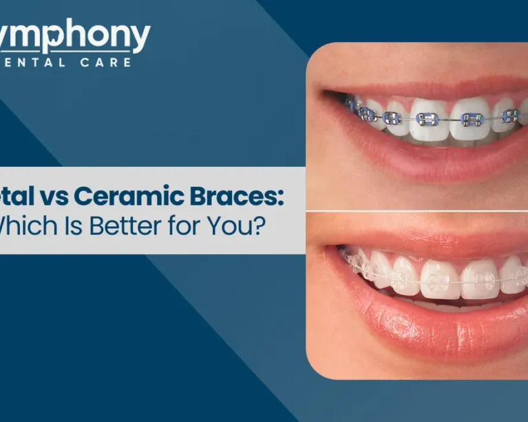 Metal vs Ceramic Braces Which Is Better for You
