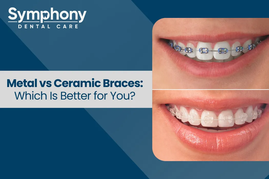 Metal vs Ceramic Braces Which Is Better for You