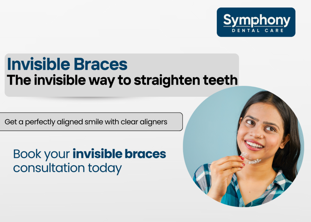 Invisible braces