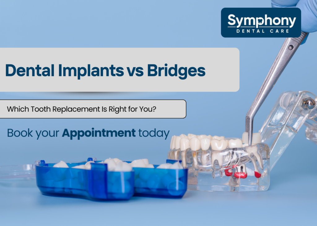 dental implants vs bridges