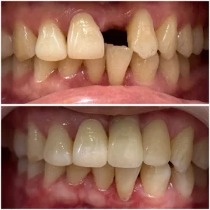 Dental Implants Treatment Results