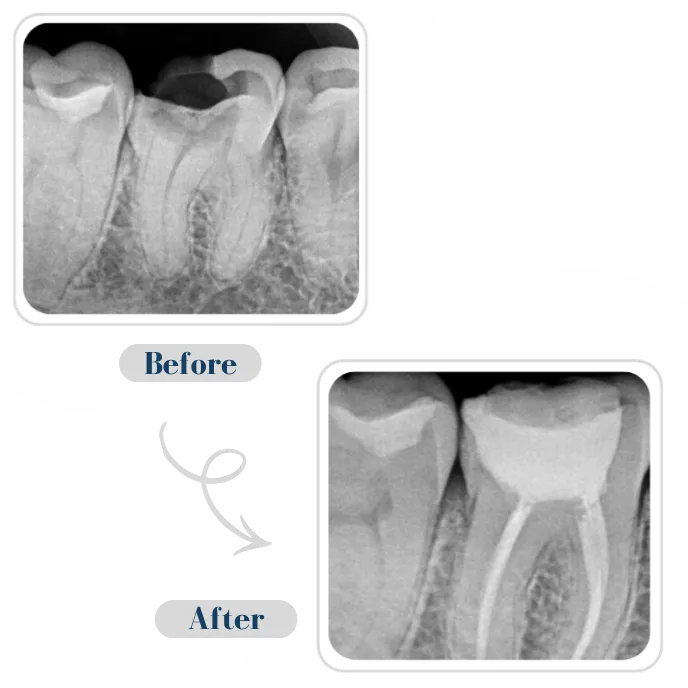 Root Canal Treatment Results