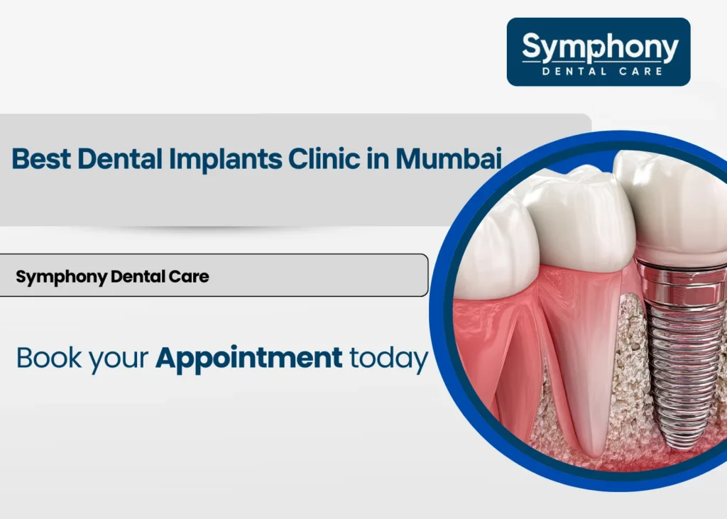 dental implants in Mumbai