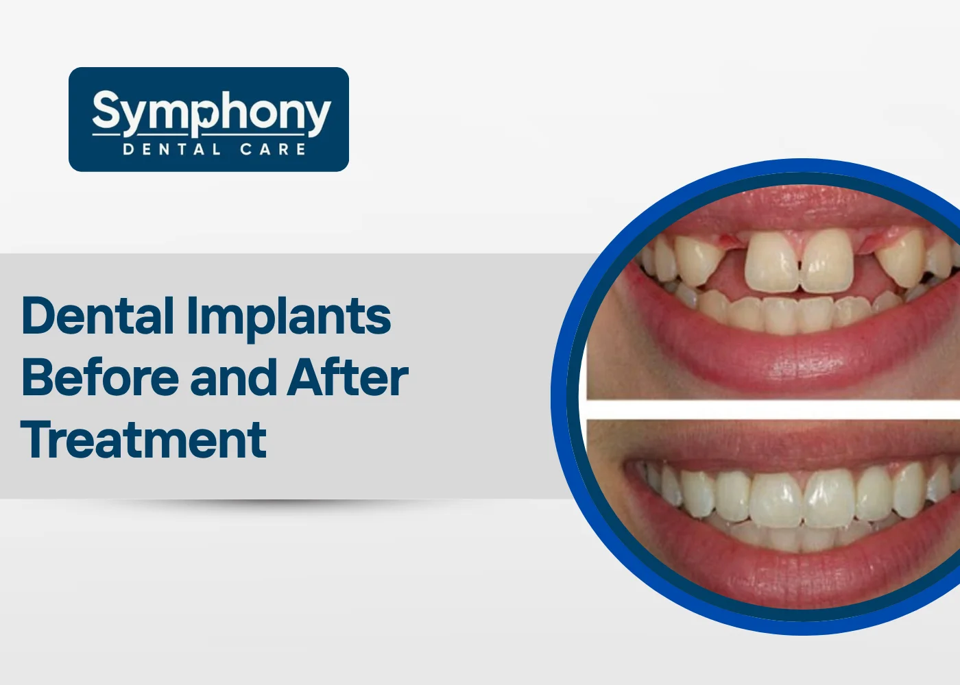 dental implants before and after treatment
