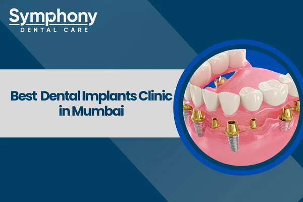 dental implants clinic in Mumbai