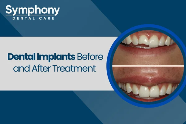 dental implants before and after