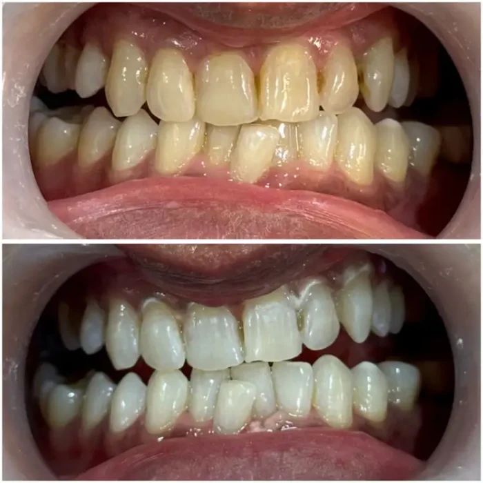 Teeth Whitening Treatment Bandra