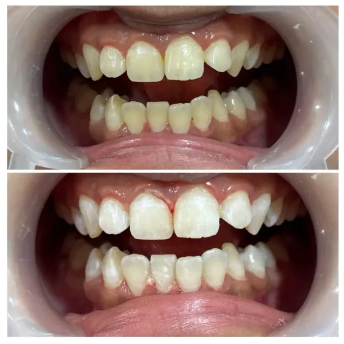 Teeth Whitening Treatment Results