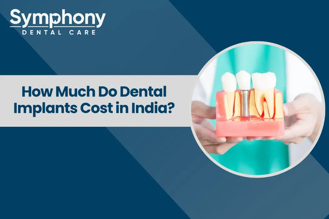 Dental Implants Cost in India