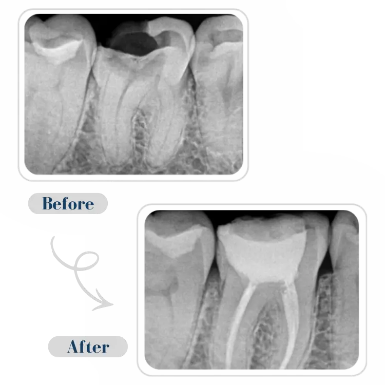 Root Canal Treatment Results