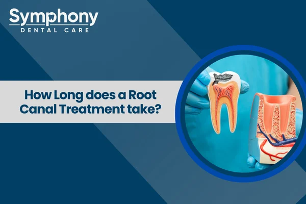 root canal treatment time