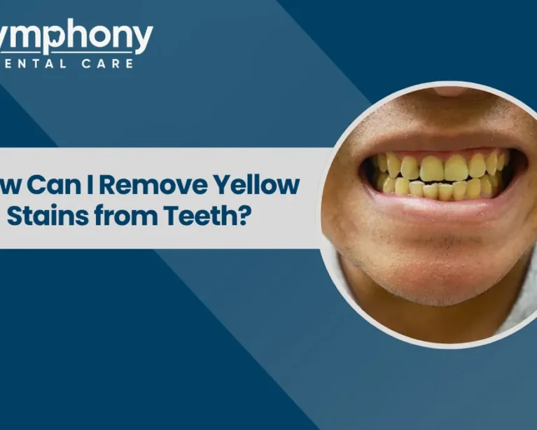 yellow teeth treatment near me