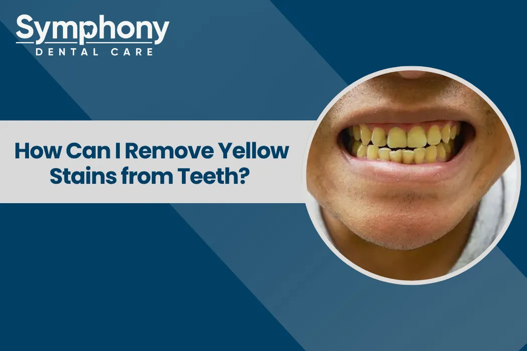 yellow teeth treatment near me