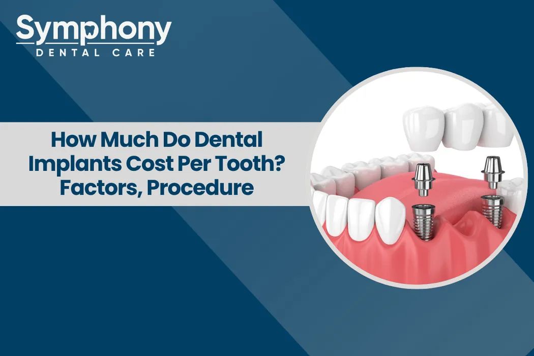 How Much Do Dental Implants Cost Per Tooth