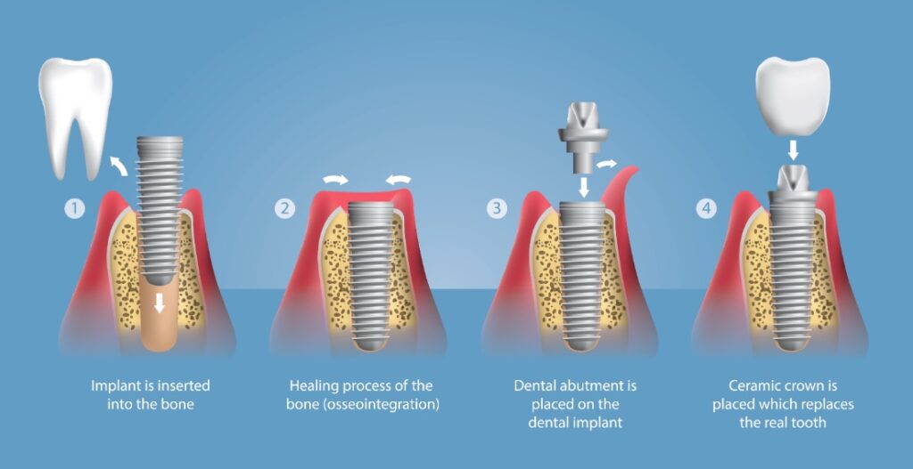 Tooth implant process