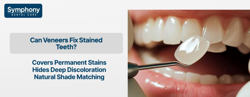 cosmetic dentist in Bandra fixing permanent tooth discoloration with veneers