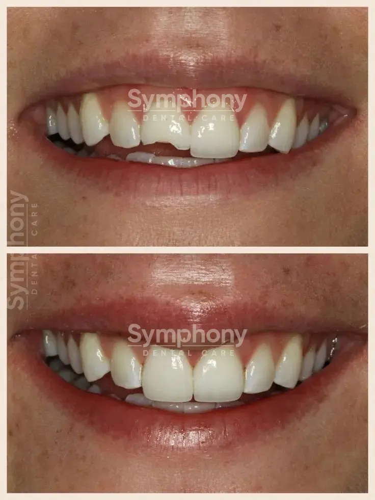 Broken Tooth Treatment results