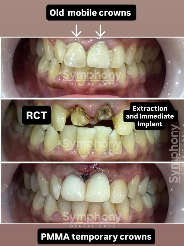 root canal treatment results