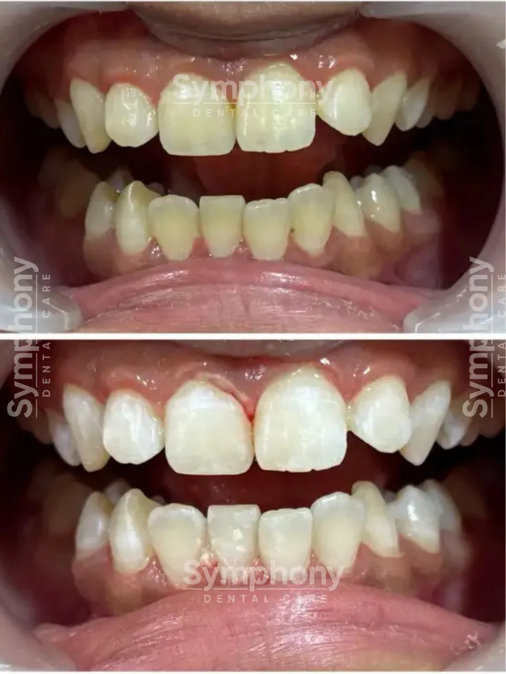 smile makeover Mumbai