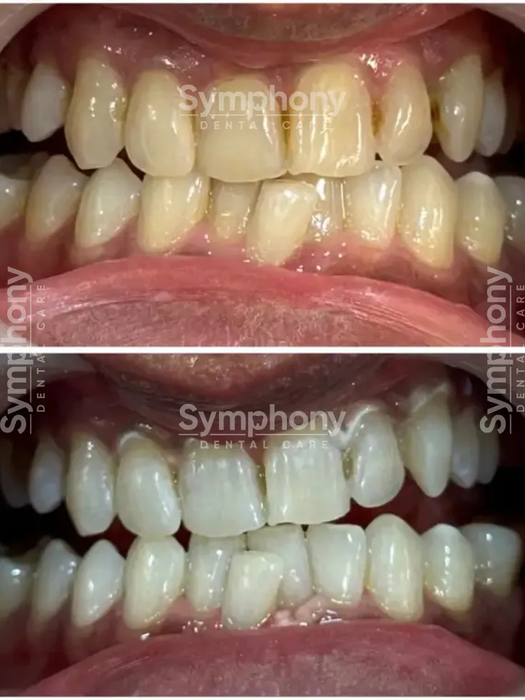 smile makeover results