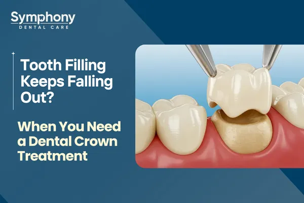 Dental Crown treatment for broken tooth