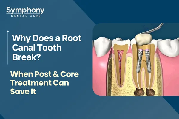 Post & Core Treatment after root canal