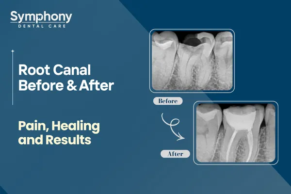 Root canal before & after results