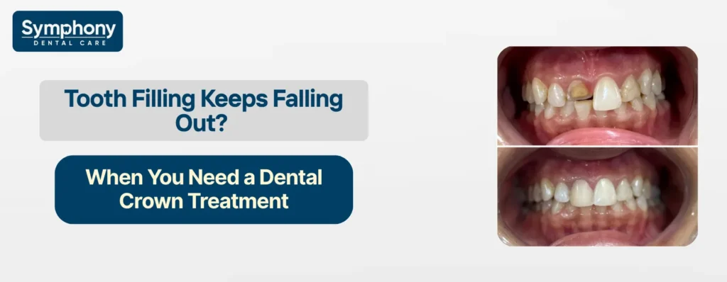 Tooth Filling Keeps Falling Out