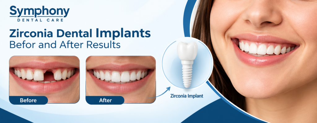 Zirconia Dental Implants