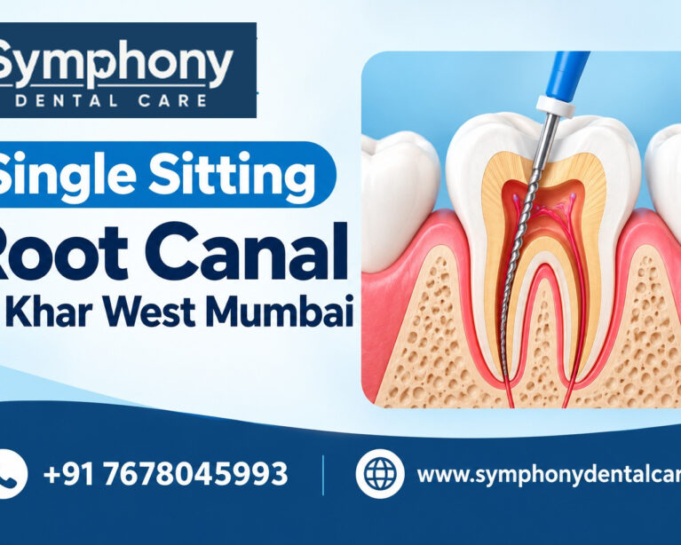 Root Canal in Khar West Mumbai
