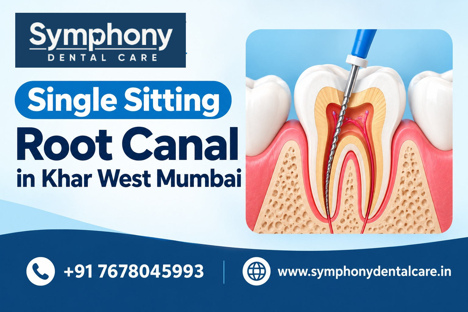 Root Canal in Khar West Mumbai